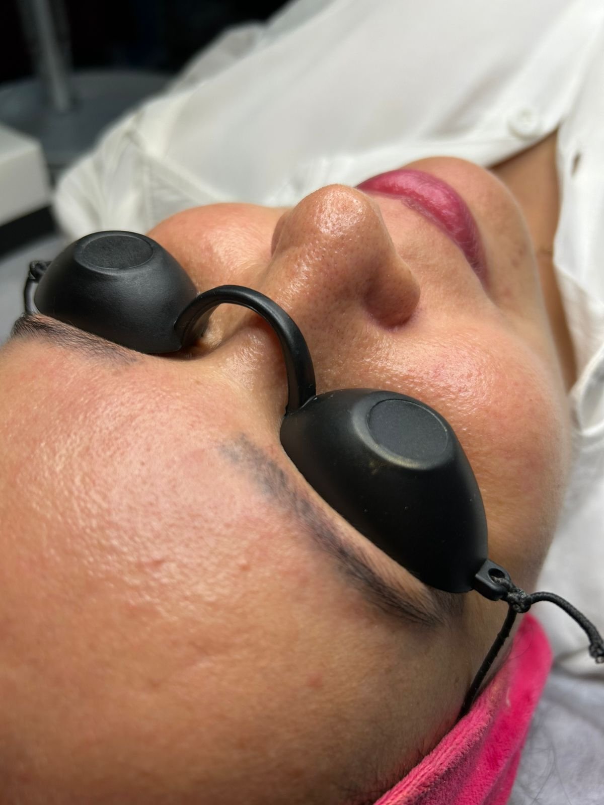 Antes - Limpeza de Pele Profissional