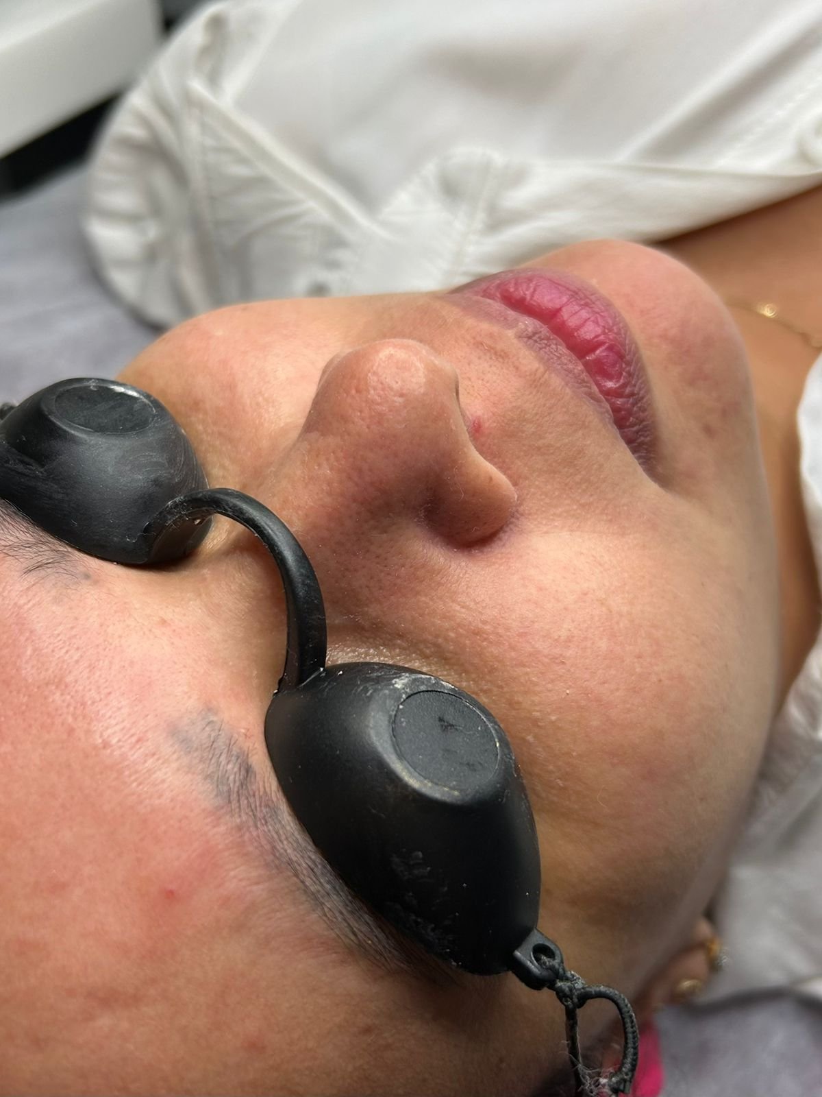 Depois - Limpeza de Pele Profissional