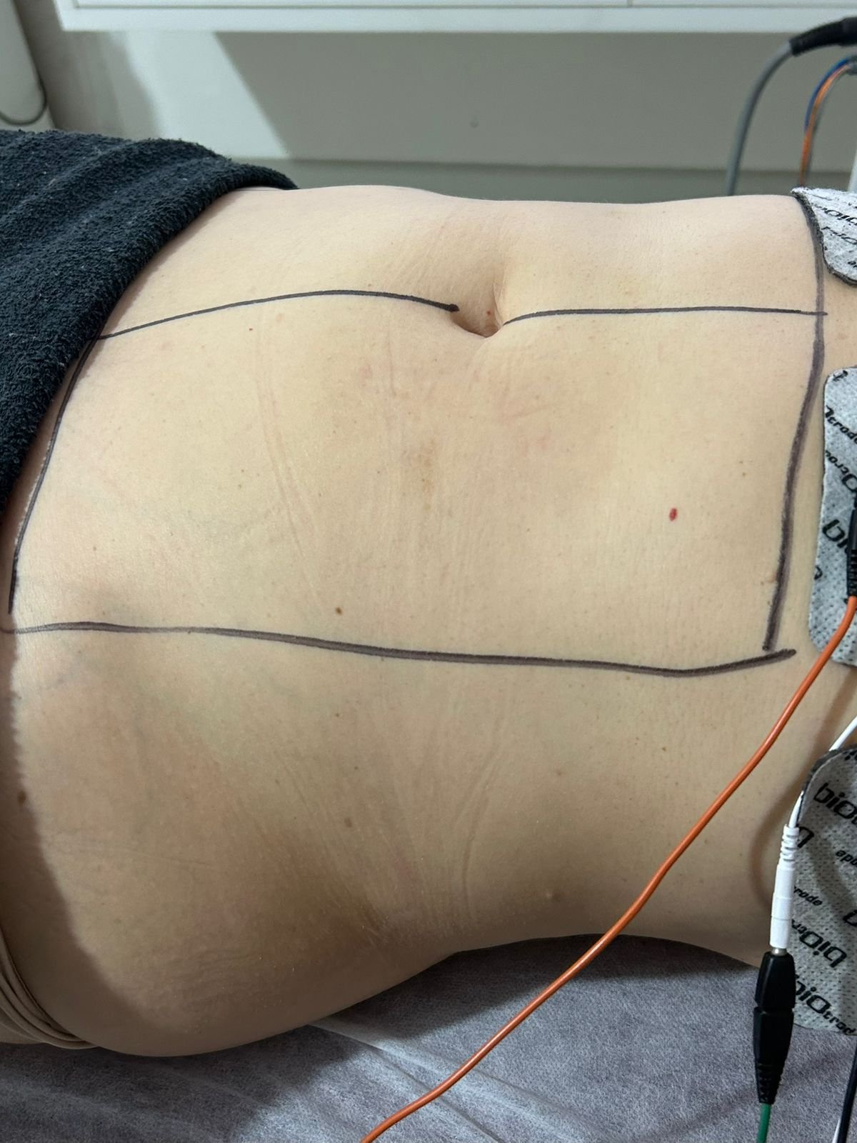 Antes - Protocolo Personalizado