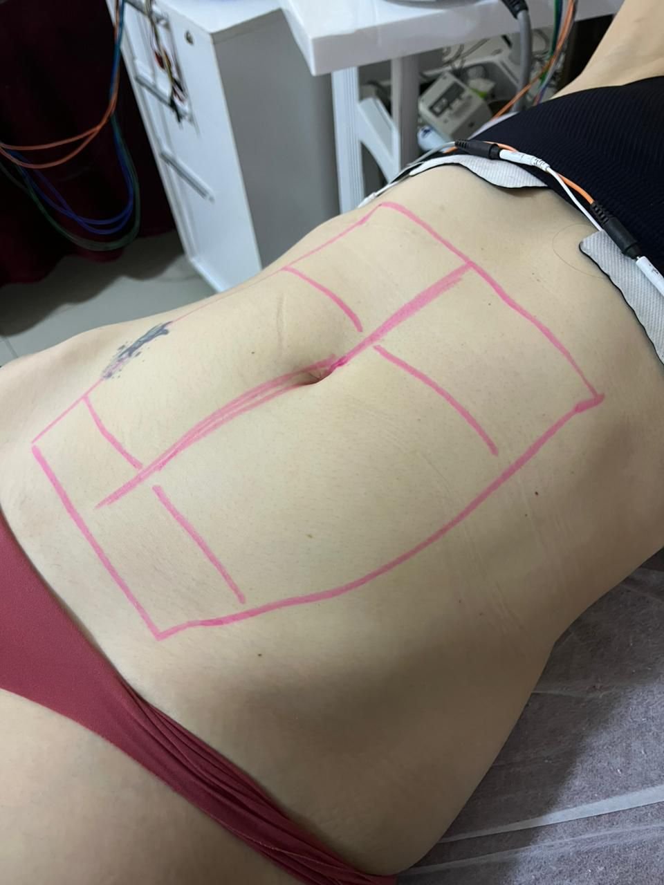 Antes - Protocolo Personalizado